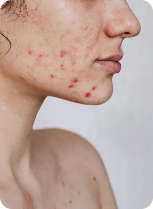Akne och inflammation