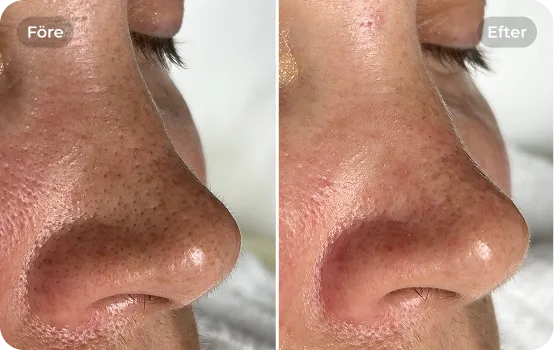 Ansiktsbehandling - peeling 1