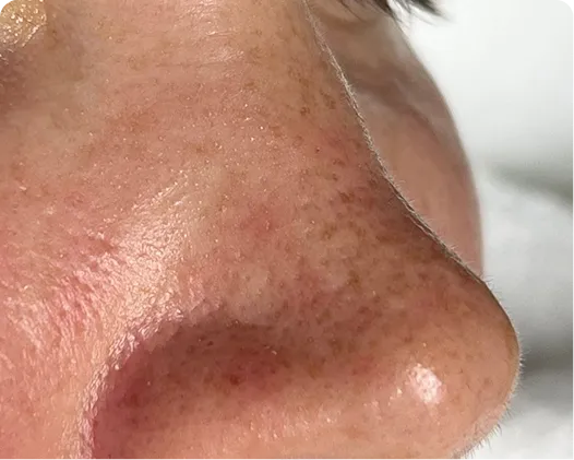 Ansiktsbehandling - peeling-after