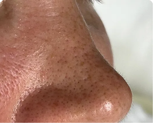Ansiktsbehandling - peeling_berfore