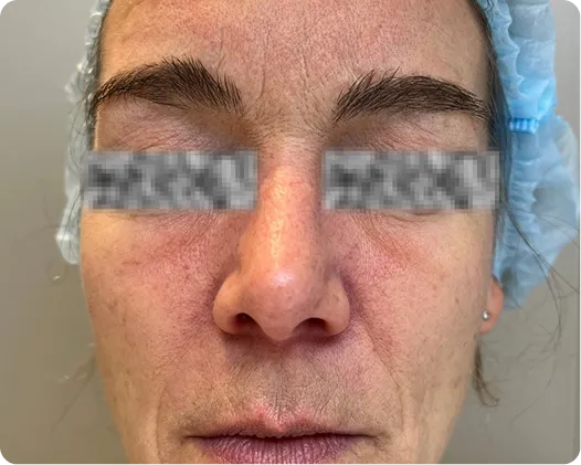 Microneedling-before