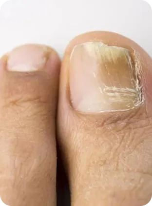 Nagelsvamp