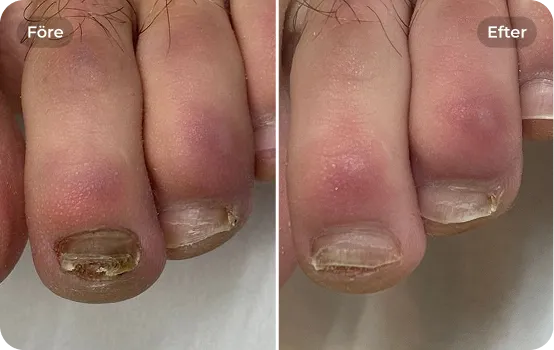 Nagelsvampbehandling 1