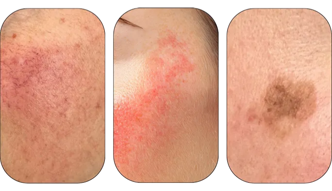 Skin program