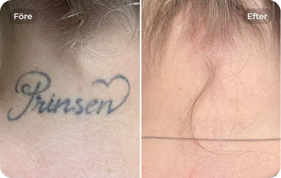 Tatueringsborttagning 1