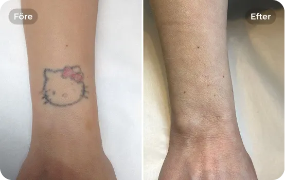 Tatueringsborttagning