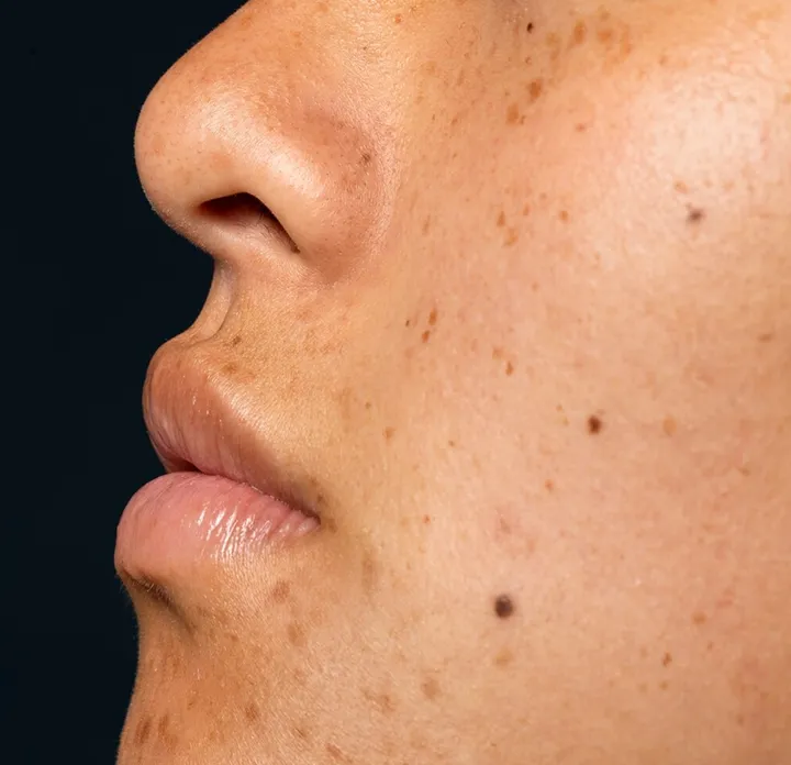 Redness, Visible Vessels, Rosacea
