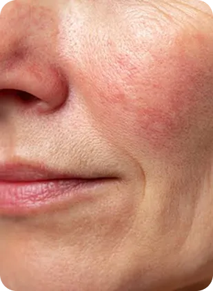 Rodnad-karl-rosacea-image