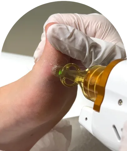 Foot laser treatment