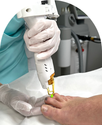 Toe laser treatment