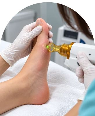 Clinical Foot Laser Treatment