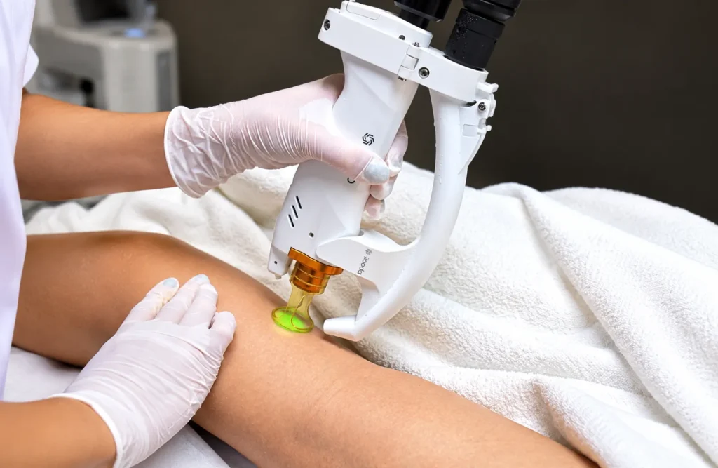 Laser Treatment on Leg