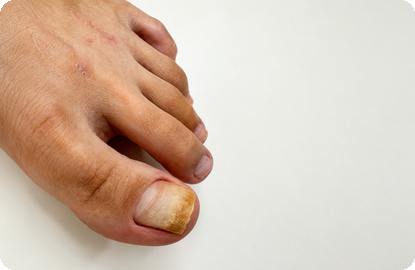 NAIL FUNGAL