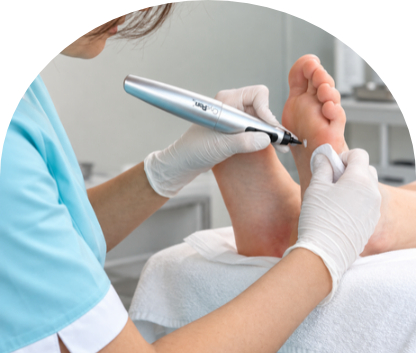 Podiatry Treatment with CryoPen