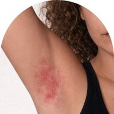 irritation efter rakning