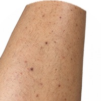 mörkare märken efter inflammation