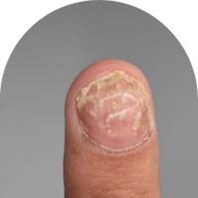 nageln känns skör och kan lätt gå sönder