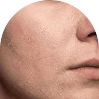 tilltäppta porer eller pormaskar