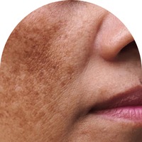 melasma (hormonell pigmentering)